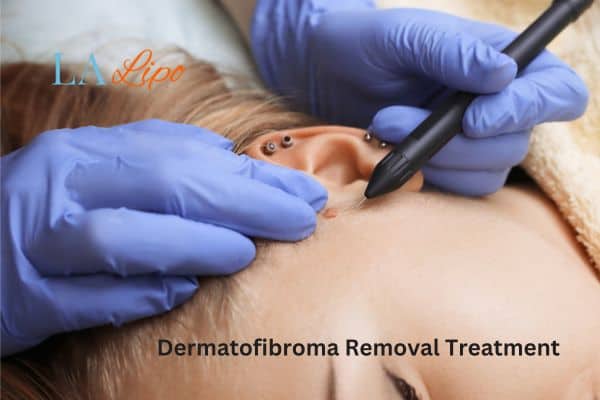 Dermatofibroma Removal Treatment Chelmsford
