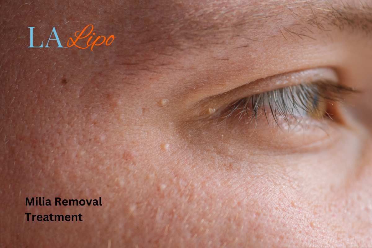 Cryopen Milia Removal: Is It the Easiest and Safest Option Chelmsford?