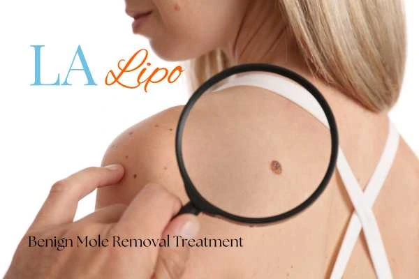 Woman having her inspection of blemish before mole removal Chelmsford