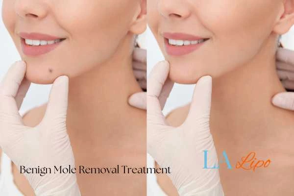 Before and after mole removal Chelmsford treatment
