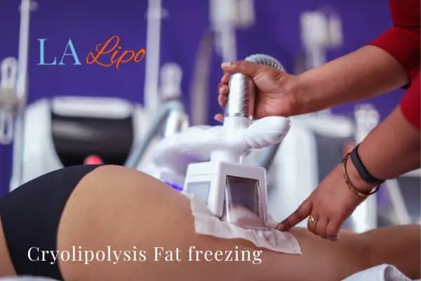 women getting fat freezing Chelmsford