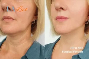hi-fu for wrinkles Chelmsford before and after results