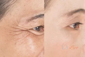 Before and after results of woman - HI-fu wrinkles reduction treatment Chelmsford