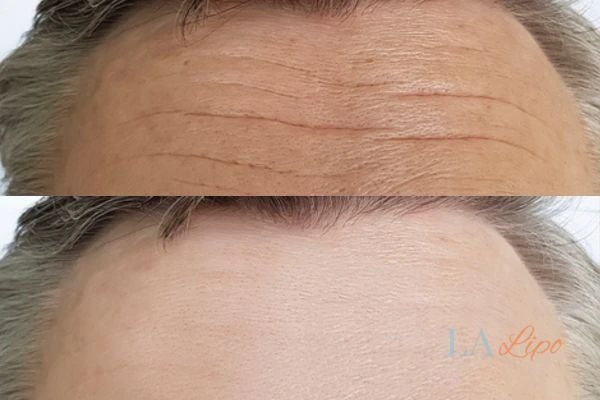 results of HIFU Chelmsford on mans forehead to help reduce lines and wrinkles