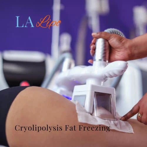 fat freezing - Cryolipolysis Chelmsford
