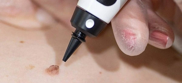 skin tag removal using cryopen Chelmsford