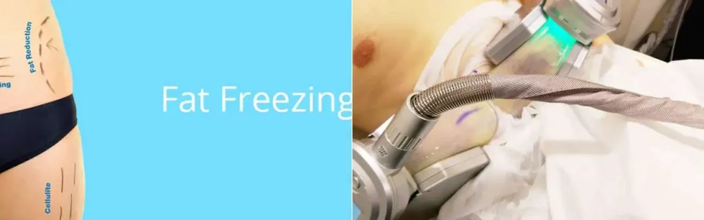 Fat freezing Chelmsford on multiple areas of the body