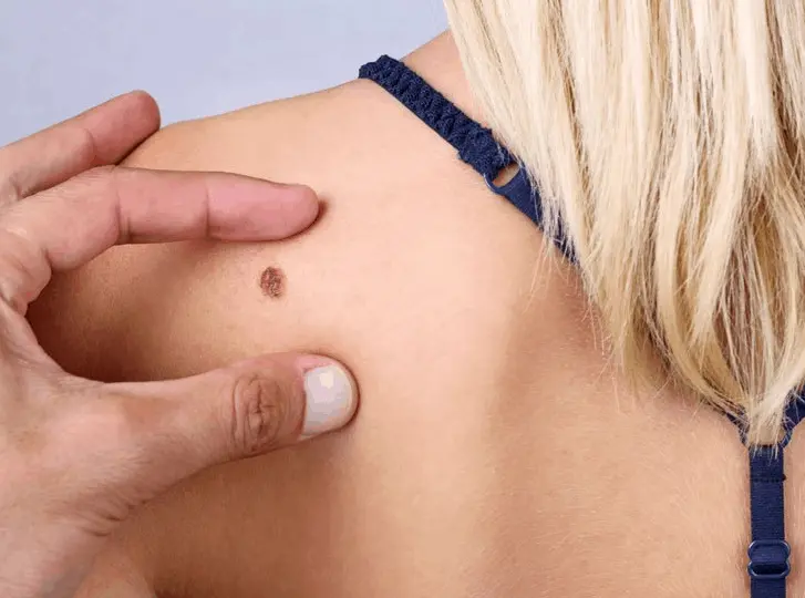 woman having mole removal Chelmsford consultation before treatment.