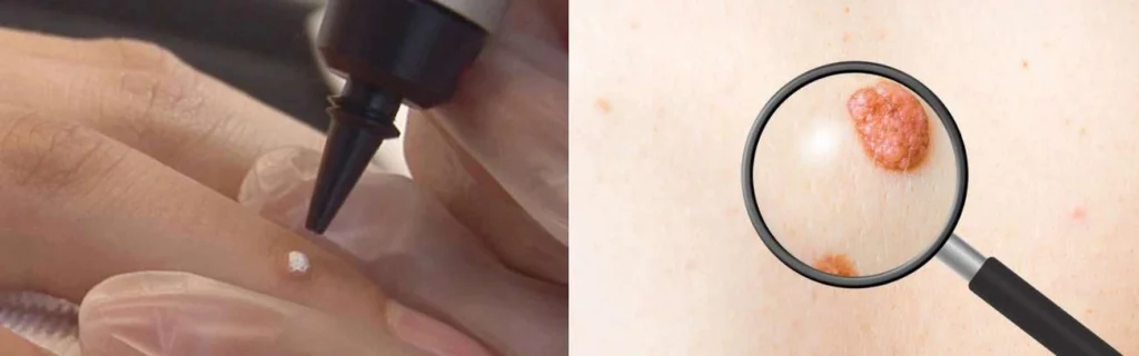 Person getting moles removed with cryopen Chelmsford