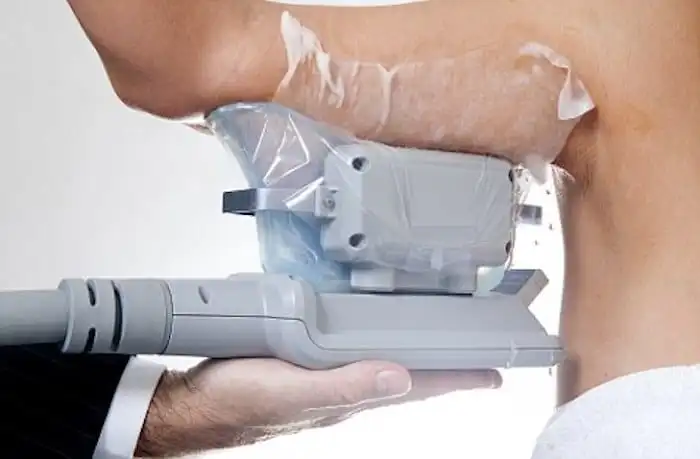 Picture of fat freezing Chelmsford on the upper arms.