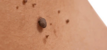 image of a skin tag Chelmsford