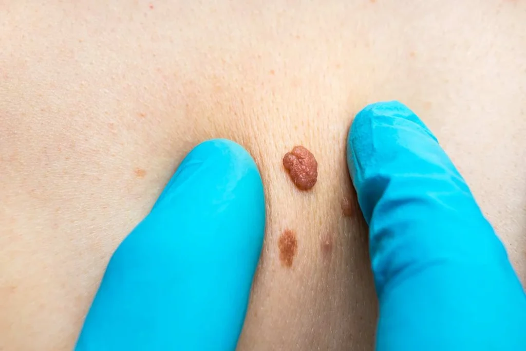Consultant examining a skin tag Chelmsford