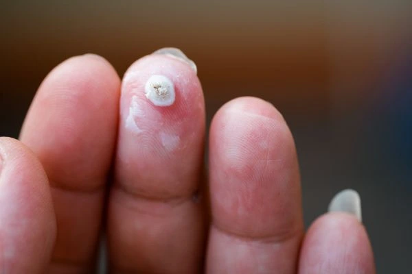 wart on person finger - cryotherapy to treat from LA LIPO Chelmsford