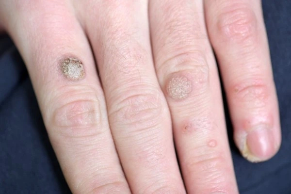 photo of warts on person hand - see wart removal Chelmsford from LA LIPO