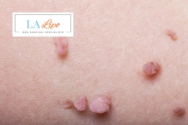 Does cryopen skin tag removal Chelmsford hurt? Find out now call our team today!