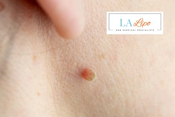 Book skin tag removal Chelmsford today speak to our team now!