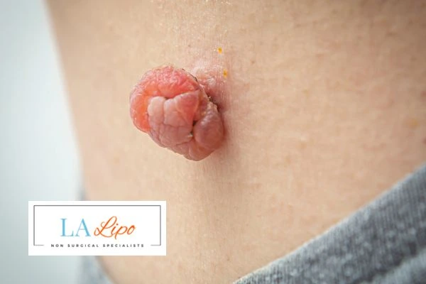 Interested in skin tag removal Chelmsford? Concerned about the pain? Find out more today!
