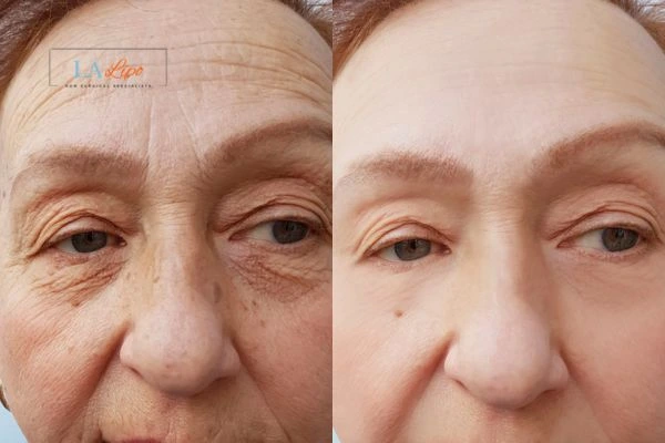 The powerful benefits of Morpheus8 Treatment Chelmsford - Call Our team today!