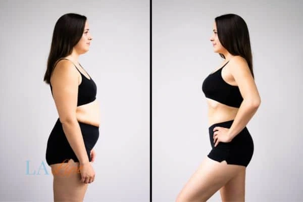 Picture of womans before and after using LA-EMS body sculpting to improve her core strength Chelmsford