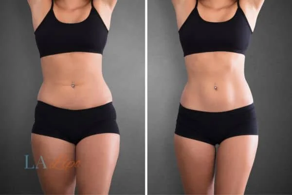 before and after results of non-surgical treatment to help a woman's body image and mental health Chelmsford