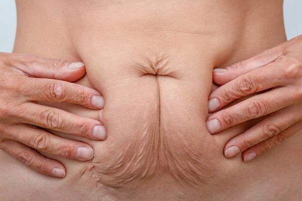 Image of a woman's stomach with loose skin - example of skin tightening Chelmsford options